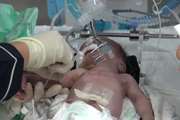 نجات جان نوزاد نارس و مادر در بیمارستان بهارلو دانشگاه علوم پزشکی تهران 
