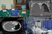 خارج کردن توده سه کیلوگرمی از قفسه صدری بیمار در مجتمع بیمارستانی امام خمینی(ره) 