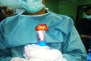 جراحی پاراتیروئیدکتومی Minimal Invasive در بیمارستان سینا انجام شد