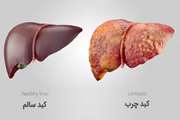 نقش کلیدی آمینواسیدها در بروز بیماری کبد چرب غیرالکلی تایید شد