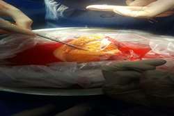 عمل جراحی ex-situ liver resection and auto transplantation در یک بیمار جوان مبتلا به سرطان کبدی پیشرفته در مجتمع بیمارستانی امام خمینی (ره) برای اولین بار در دانشگاه علوم پزشکی تهران