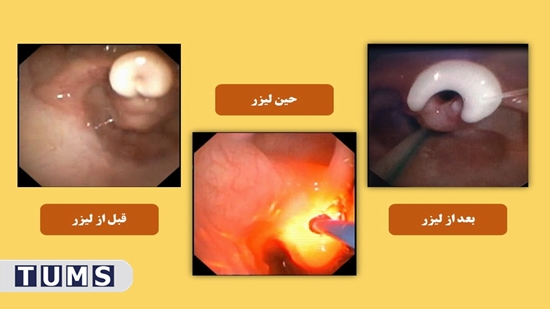 استفاده از لیزر برای درمان نرمی حنجره در بخش ریه مرکز طبی کودکان با موفقیت انجام شد 